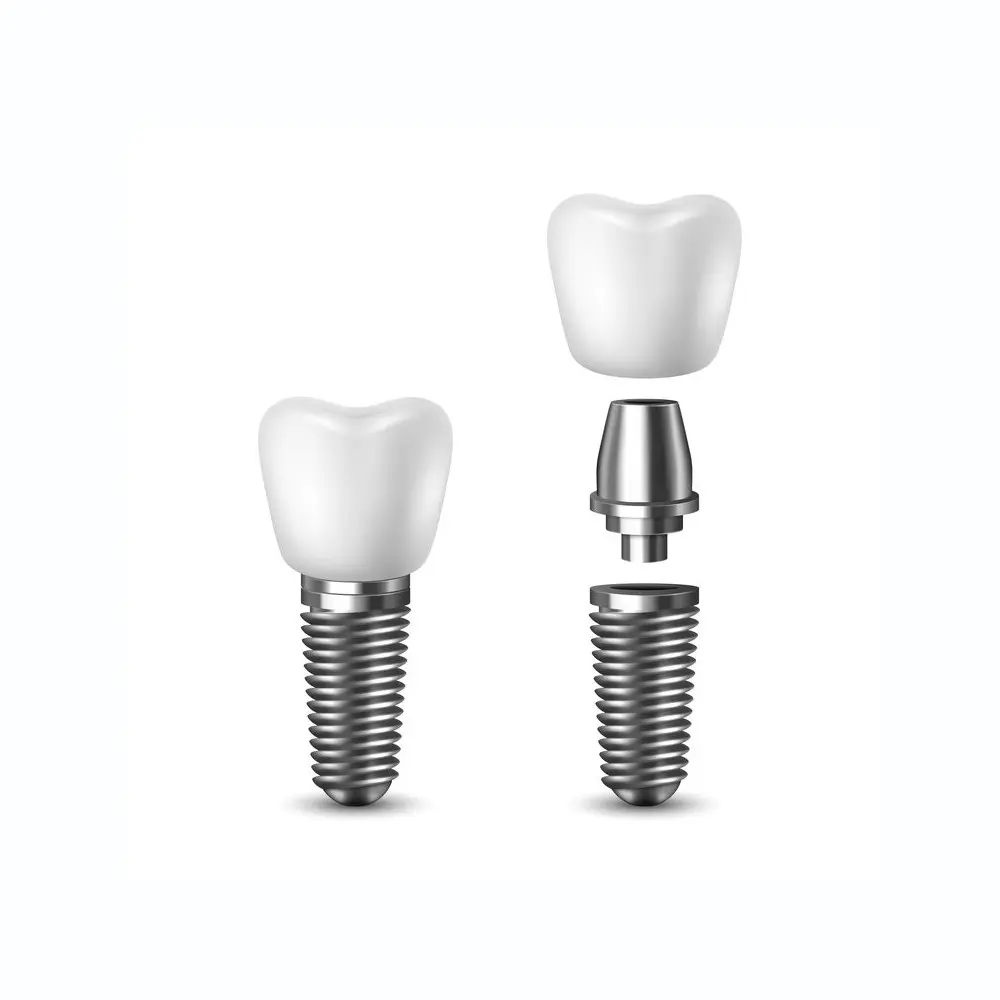 dental implants - single tooth implant
