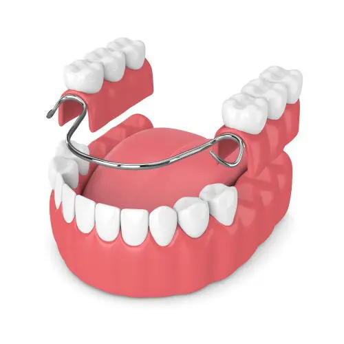 cast metal partial dentures