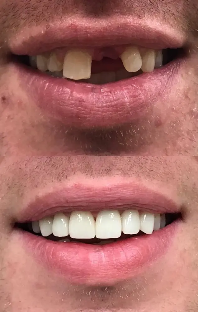 before and after Single Tooth Implants