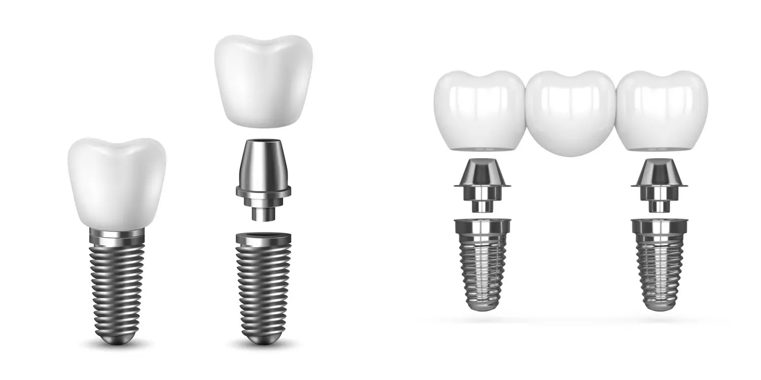 Single tooth implant and implant bridge