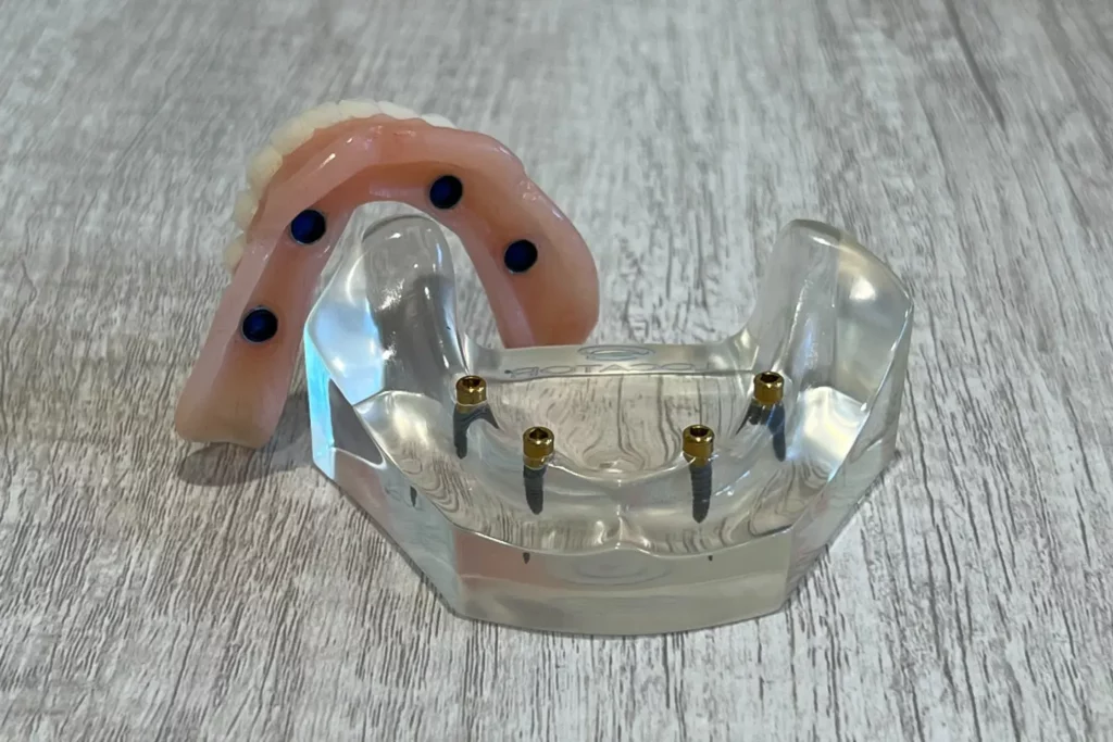 Snap-In Implant Dentures unsnapped