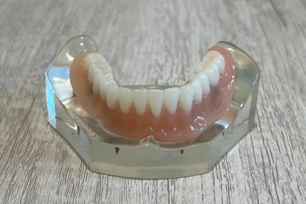Snap-In Implant Dentures snapped