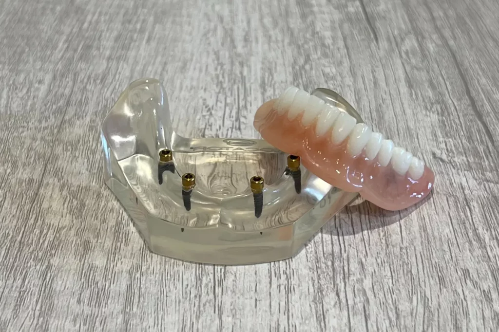 Snap-In Implant Dentures
