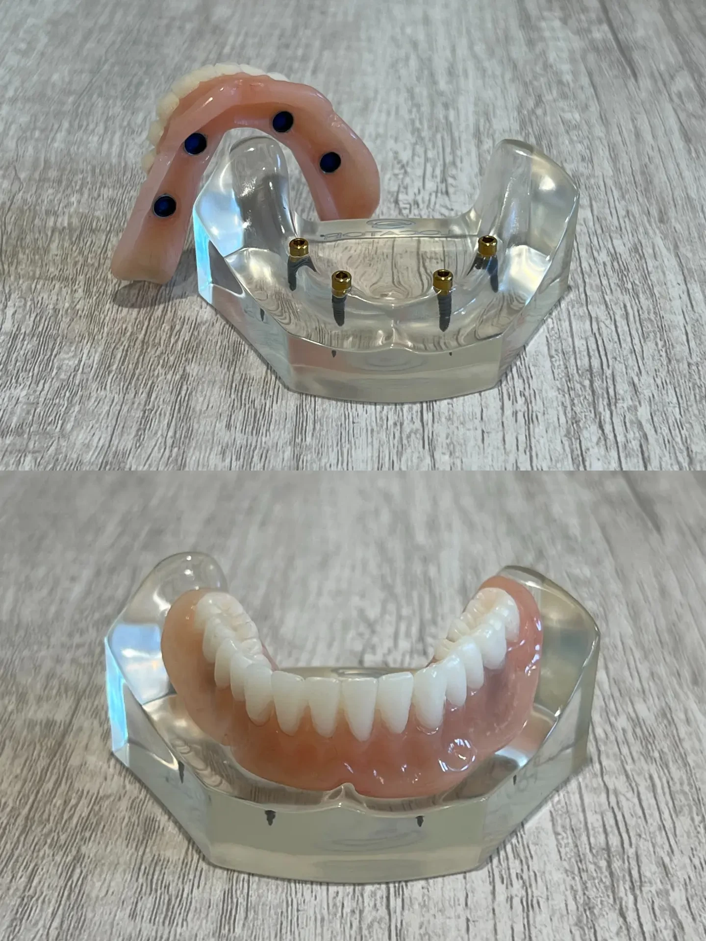 Snap-In Implant Dentures snapped and unsnapped